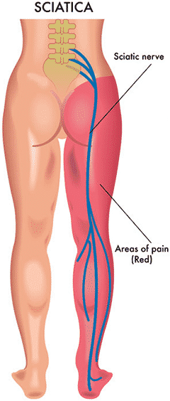 diagram of human body showing where sciatic nerve is for sciatica relief in 8 minutes