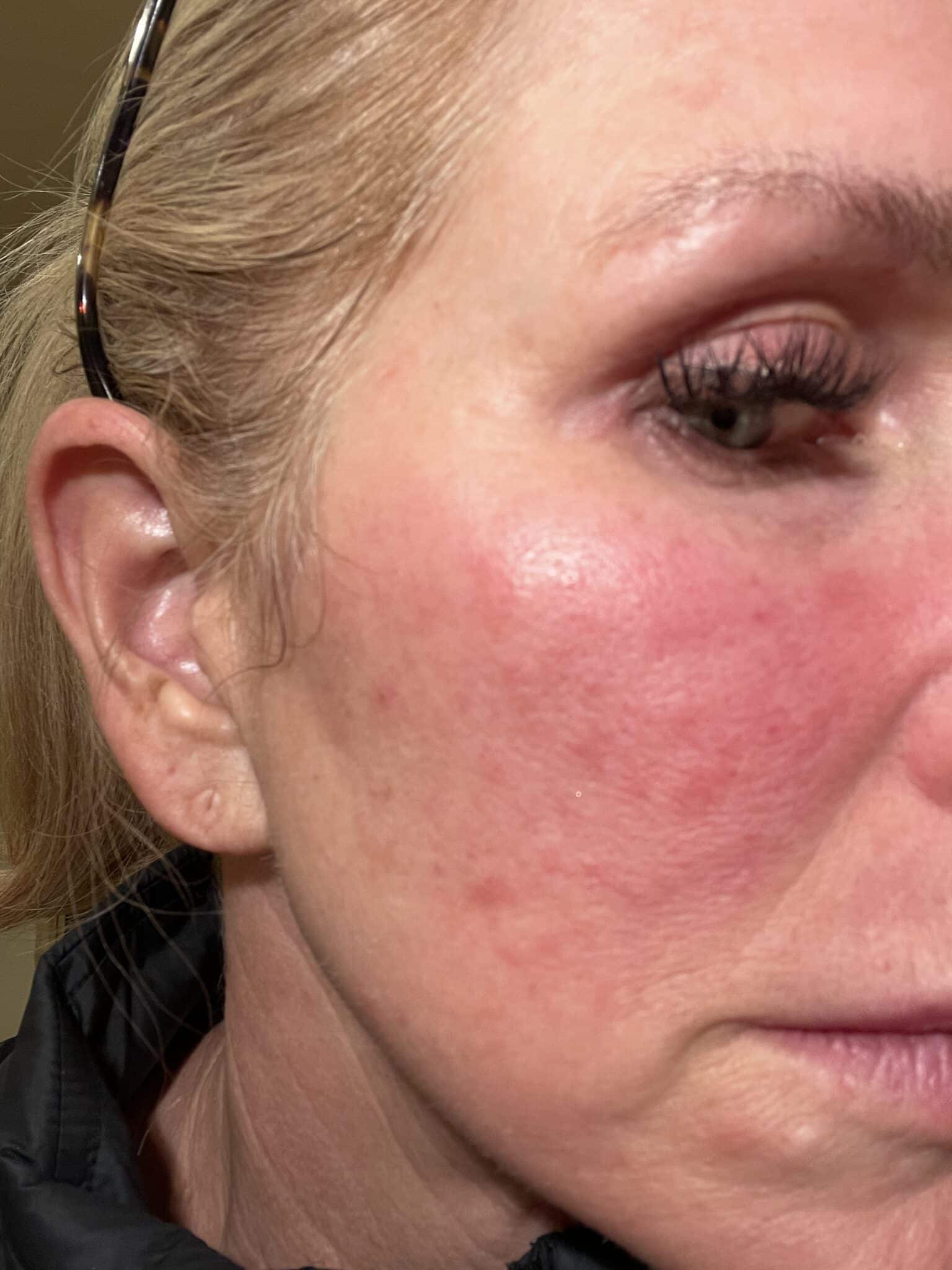 Woman showing face with rosacea.