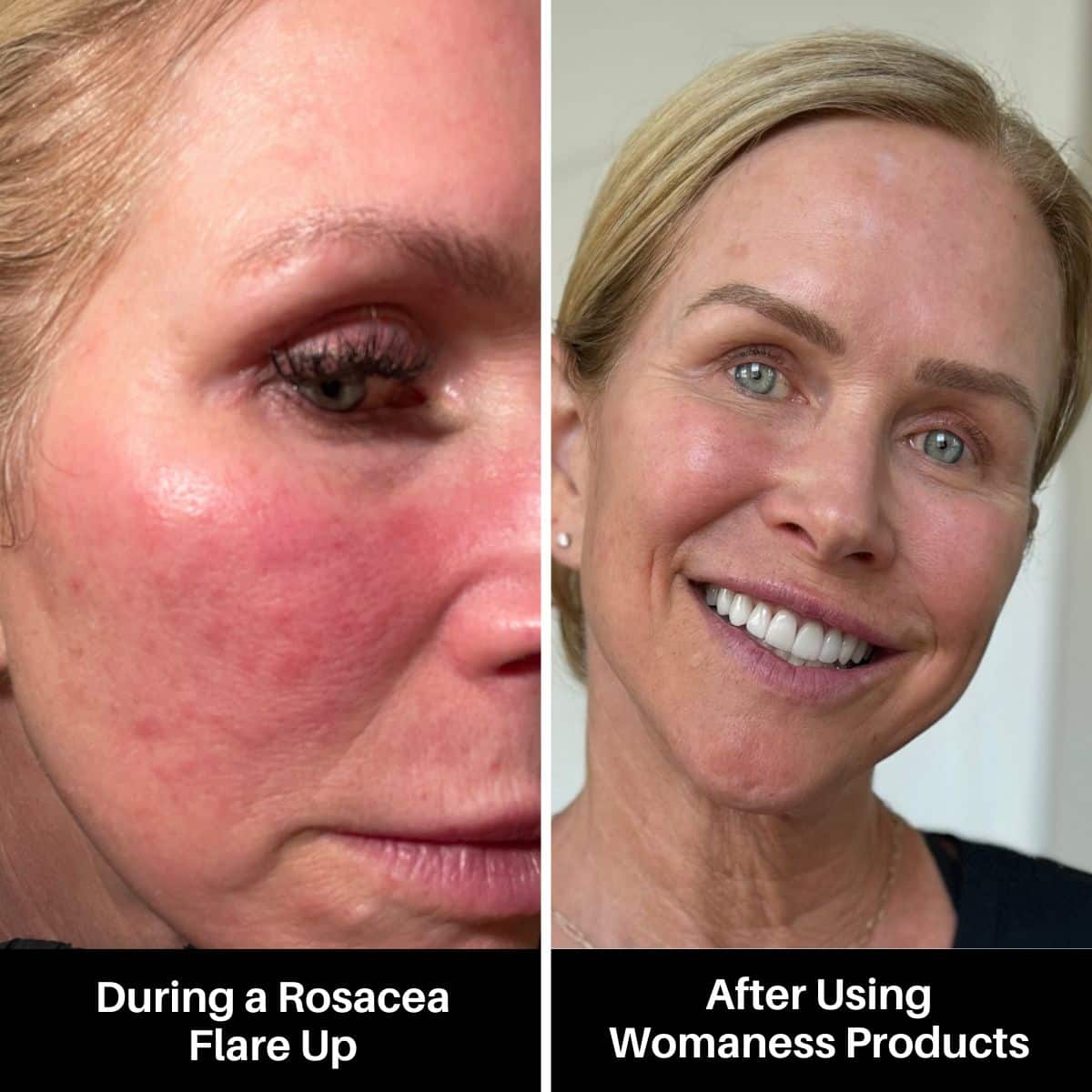 before and after rosacea flare up with womaness skincare products